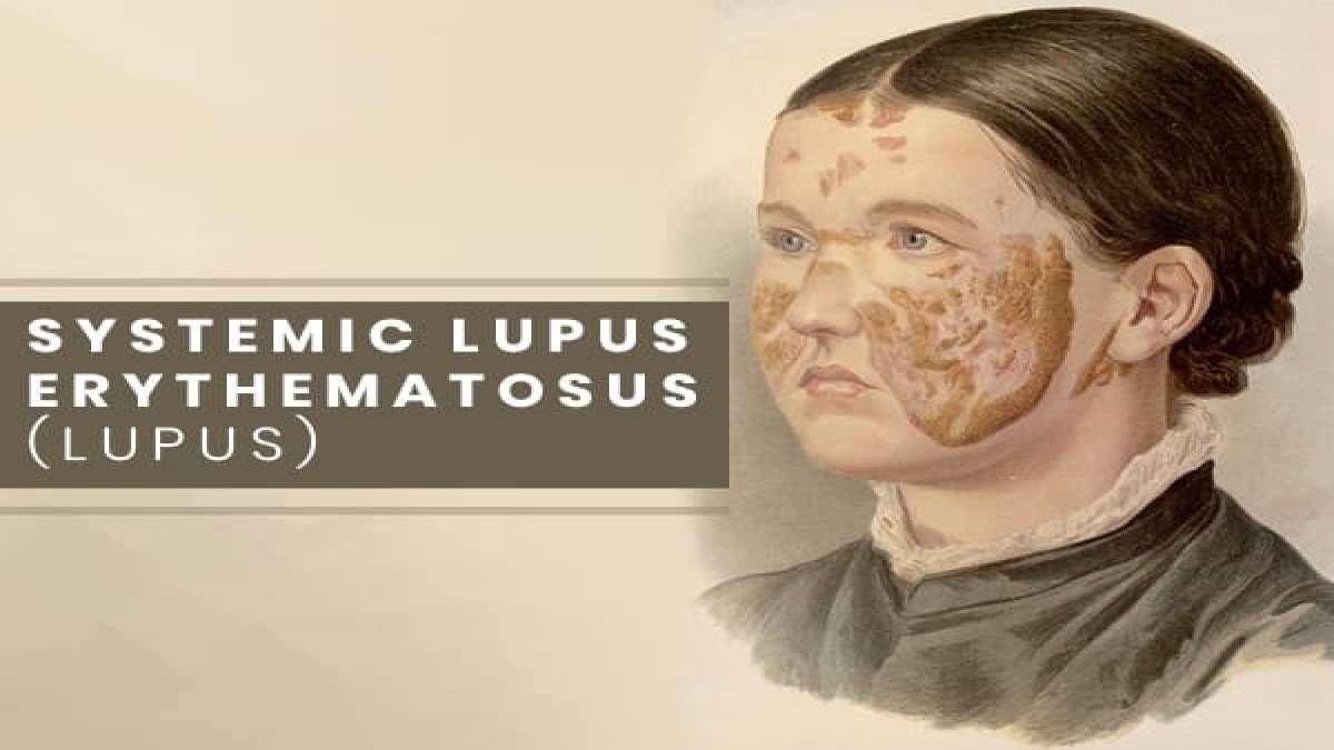Systemic Lupus Erythematosus মাইকেল জ্যাকসন ভুগছিলেন এই কঠিন রোগে