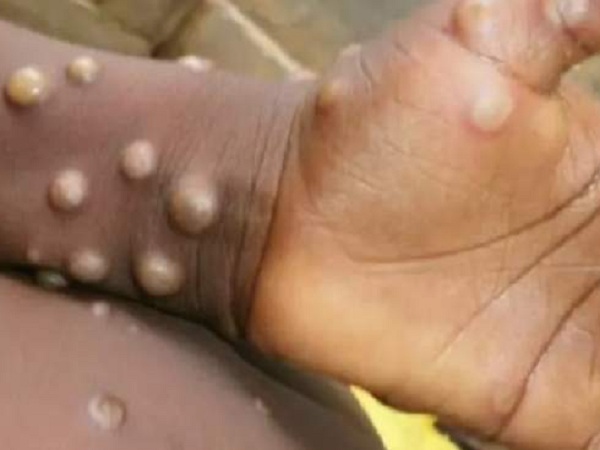 মাঙ্কিপক্সের চিকিৎসা