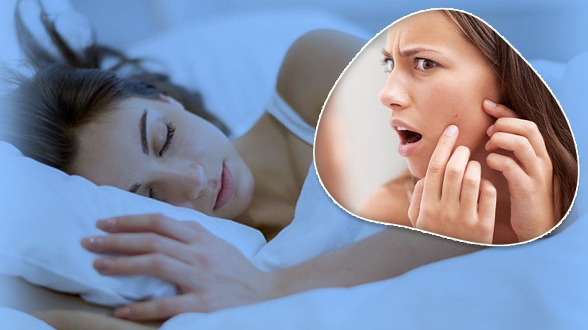ব্রণর সমস্যা থেকে মুক্তি চান? আজই বদলান আপনার ঘুমানোর স্টাইল! Common